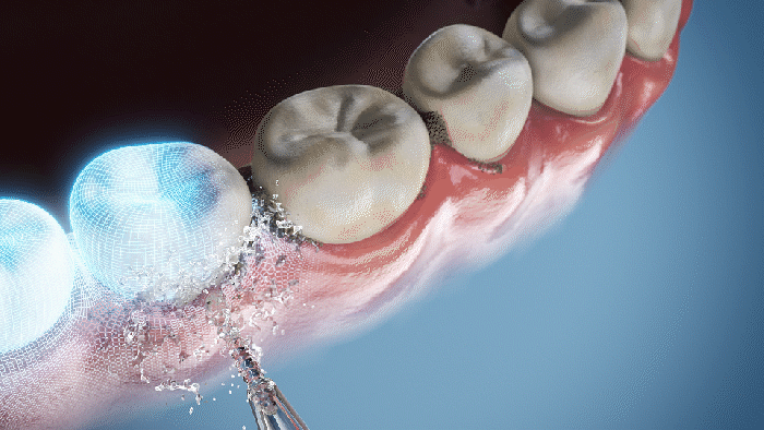 خيط الأسنان بالضغط المائي